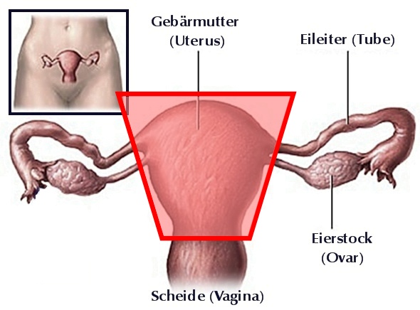 Gebärmutterentfernung nach der Gebärmutterentfernung (Hysterektomie)